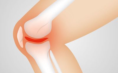 arthrocalman-g1bd88c547_1920