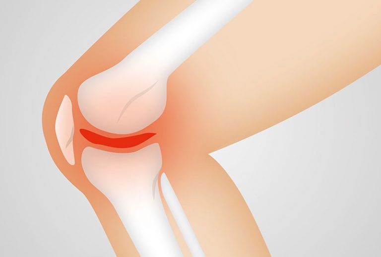 arthrocalman-g1bd88c547_1920