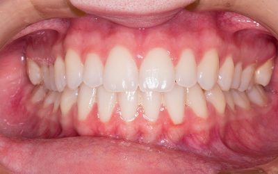 teeth-gb6e5c1b6c_1920