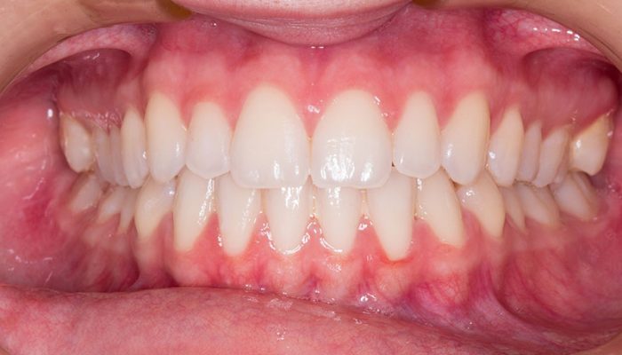 teeth-gb6e5c1b6c_1920