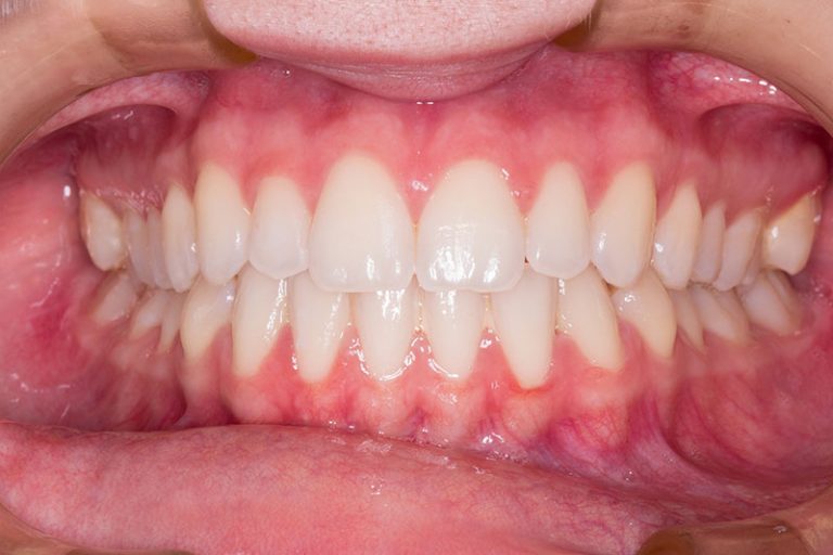 teeth-gb6e5c1b6c_1920