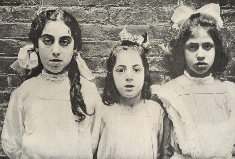 adenoid faces